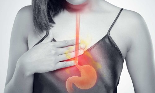 Acid Reflux, Heartburn and its Symptoms