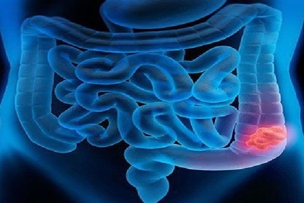 Colon Cancer Surgery