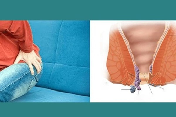 Piles Treatment