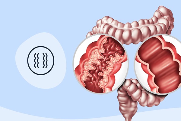 Best Treatment for Inflammatory Bowel Disease in Sarjapur Road – Expert Care by Dr. Lohith