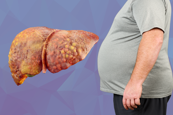 Fatty Liver Disease: Causes, Symptoms, Stages, and Treatment