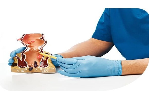 Fistula Treatment