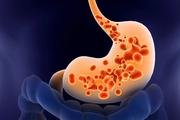 GERD (Acid Reflux): Symptoms, Causes, and When You Need Treatment