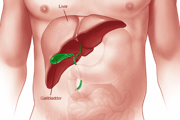 Laparoscopic Surgery for Gallstones: Who Needs It?