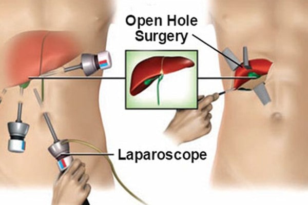 laparoscopic surgery vs open surgery