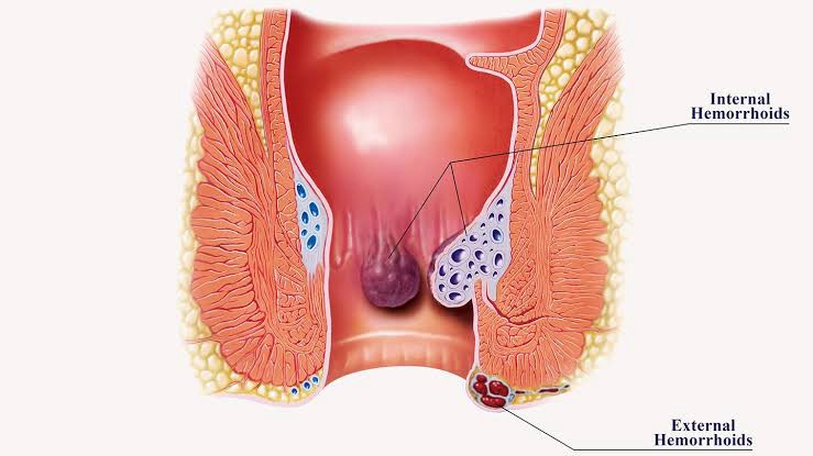 Understanding and Managing Hemorrhoids