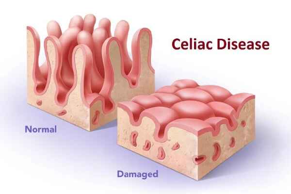 Understanding Celiac Disease: Symptoms, Diagnosis, and Management